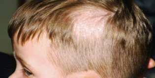 лишай у ребенка