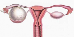 Киста яичника 