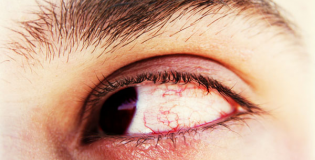 хронические воспаления глазного яблока