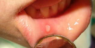 Сыпь во рту