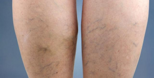 Сосудистые звездочки на ногах