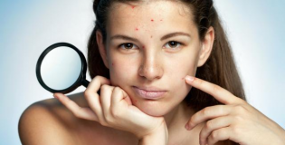 Прыщи на лице