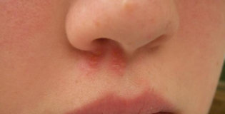 Герпес в носу
