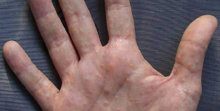 Дисгидротическая экзема