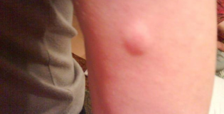 Липома на руке