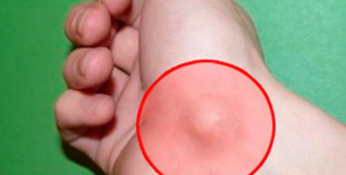 Гигрома на запястье