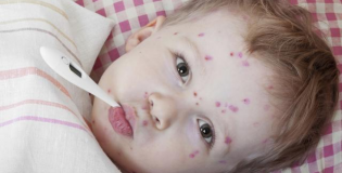 Сыпь при ветрянке