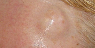 Жировик на лбу