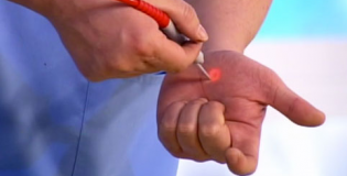 Лазерное удаление бородавок