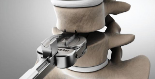 Удаление межпозвоночного диска