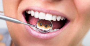 Невидимые брекеты