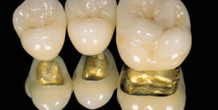 Коронка зуба