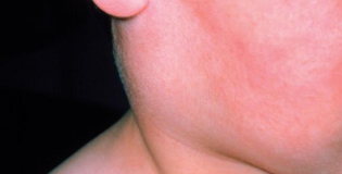 Воспаление лимфоузла под челюстью.