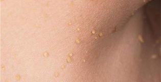 Папилломы на шее