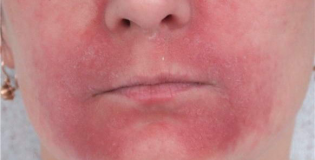 Пероральный дерматит на лице