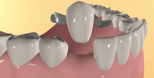 Протез зуба
