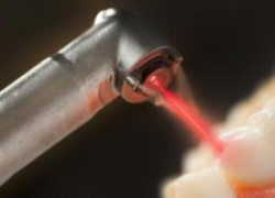 Лазер воздействует на ткани зубов Лазер воздействует на ткани зубов