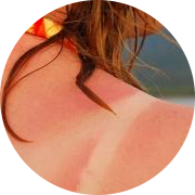 Красные следи после загара Красные следи после загара