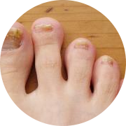 Пораженные грибком ногти Пораженные грибком ногти