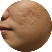 Рубцы на лице Рубцы на лице