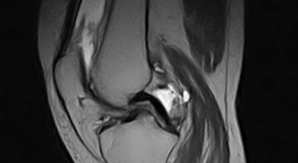 Снимок колена Снимок колена