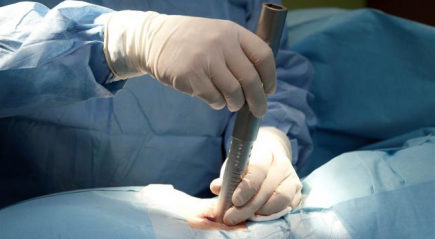 Лазерная вапоризация Лазерная вапоризация