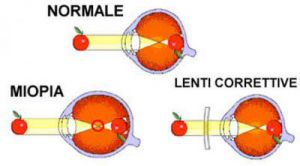 отклонение от нормы при миопии