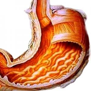 гастрит гастрит