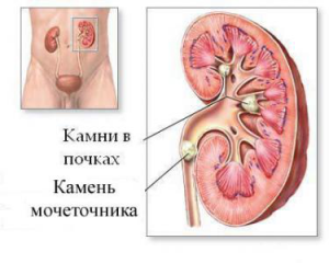 камни в почках камни в почках