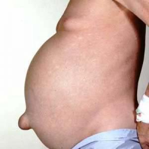 асцит асцит