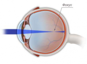 Фокусировка световых лучей при близорукости Фокусировка световых лучей при близорукости