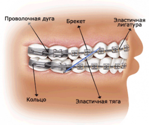 Брекет-система
