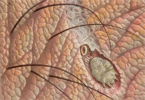 Чесоточный клещ Чесоточный клещ