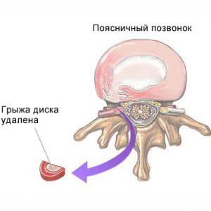 Удаление части межпозвоночного диска
