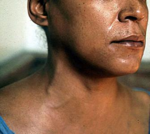 Набухание шейных вен