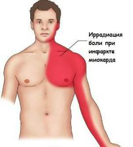 Иррадация боли при инфаркте