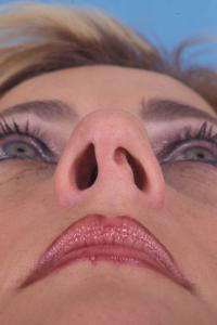 Искривление носовой перегородки фото Искривление носовой перегородки фото