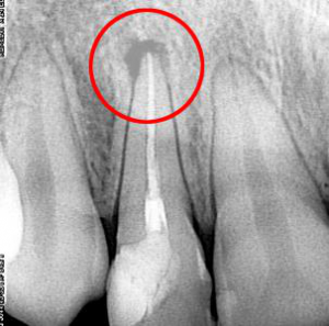 Рентгеновский снимок зуба Рентгеновский снимок зуба