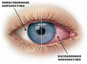 Здровая и воспаленная конъюктива