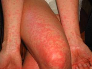 краснуха,сыпь ногах краснуха,сыпь ногах