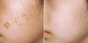 Лазерная чистка лица до и после Лазерная чистка лица до и после