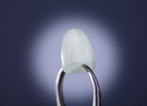 Керамическая накладка на зуб Керамическая накладка на зуб