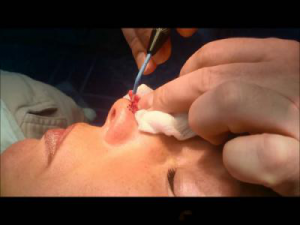 удаление гемангиомы удаление гемангиомы