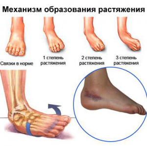 Механизм образования растяжения Механизм образования растяжения