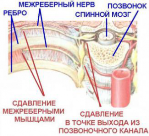 схема возникновения межреберной невралгии