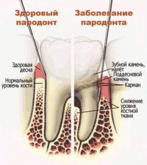 Пародонтоз Пародонтоз