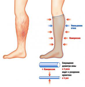 действие лечебного трикотажа действие лечебного трикотажа