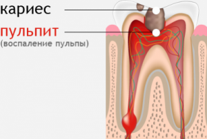 Поражение зуба кариесом