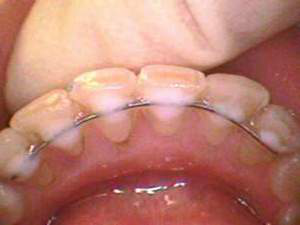 Ретейнеры после брекетов фото Ретейнеры после брекетов фото