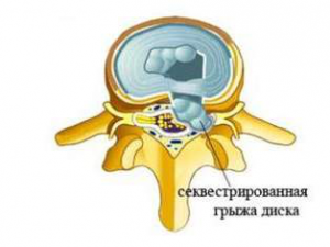 Выпадение пульпозного ядра Выпадение пульпозного ядра